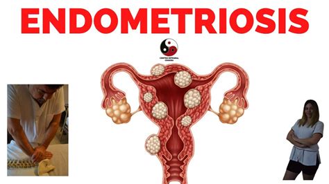 que es endometriosis y como se cura
